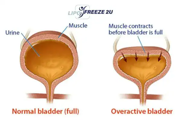 diagram of overactive bladder treatment Milton Keynes