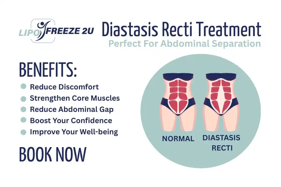 Benefits of body toning treatment Milton Keynes for Diastasis recti