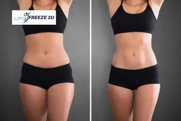 How Can LIPO FREEZE 2U Support Your Post-Pregnancy Body Recovery Milton Keynes?