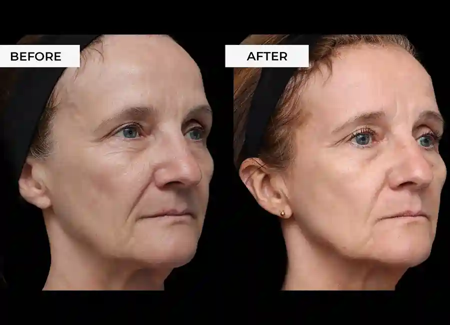 How Many RF Microneedling Sessions Will You Need to See a Difference Milton Keynes?