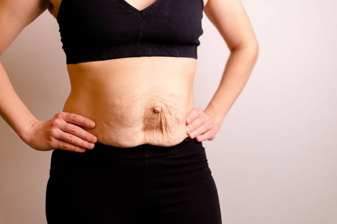 Is Surgery Really the Only Way to Repair Diastasis Recti Milton Keynes?