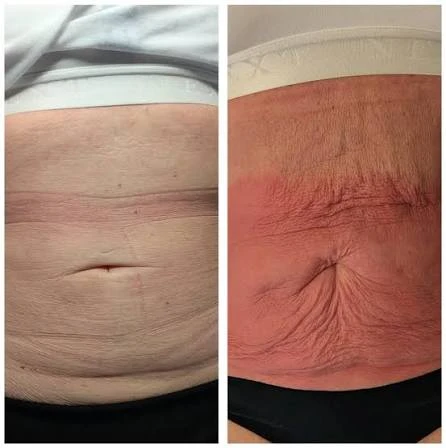 How Does RF Microneedling Improve Crepey, Thin and Uneven Skin Texture Milton Keynes?