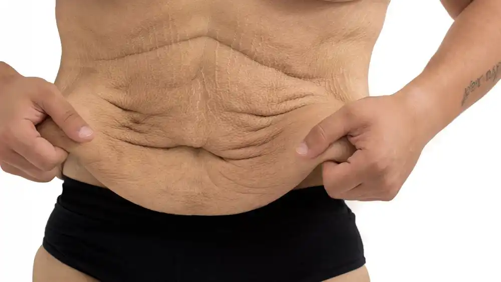 RF Microneedling for Loose Skin: How Can It Help Tighten and Reshape the Skin Milton Keynes?